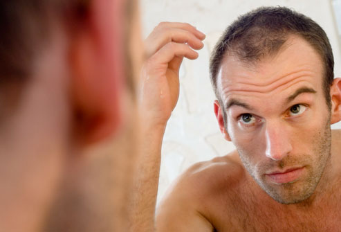 Men-Hair-Loss