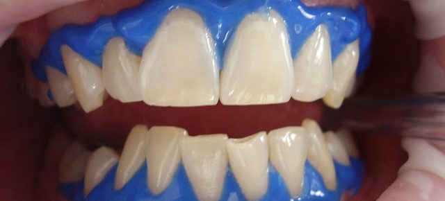 Laser teeth whitening