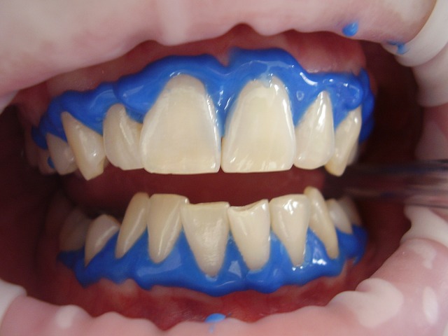 Laser teeth whitening 