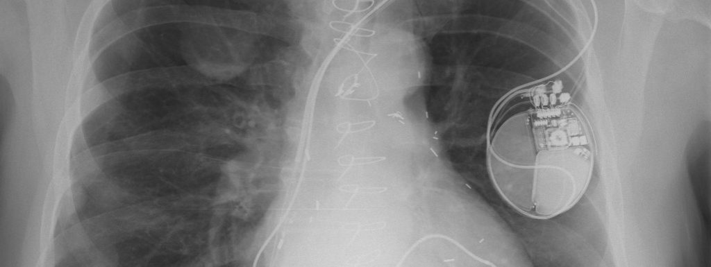 Mesothelioma- scan