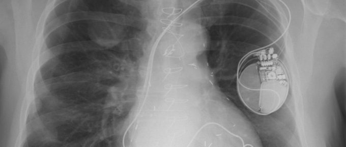 Mesothelioma- scan