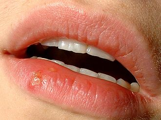Apple Cider Vinegar for herpes