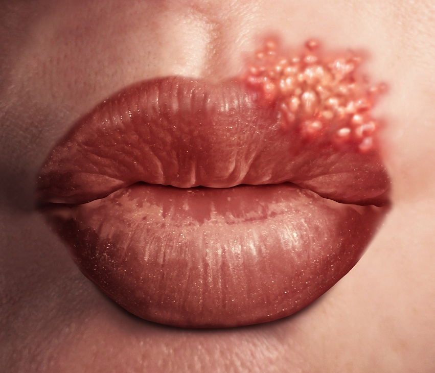 Apple Cider Vinegar for herpes