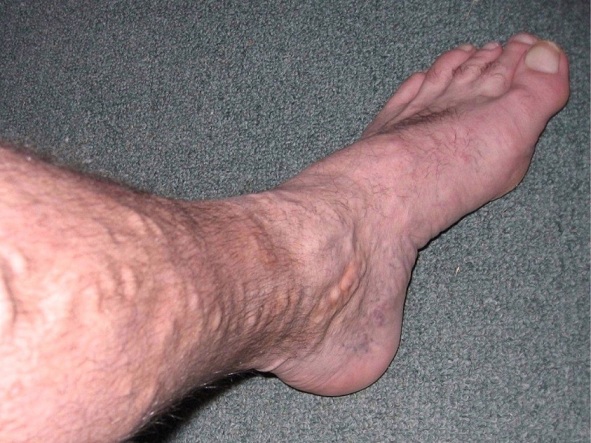 varicose-vains-men